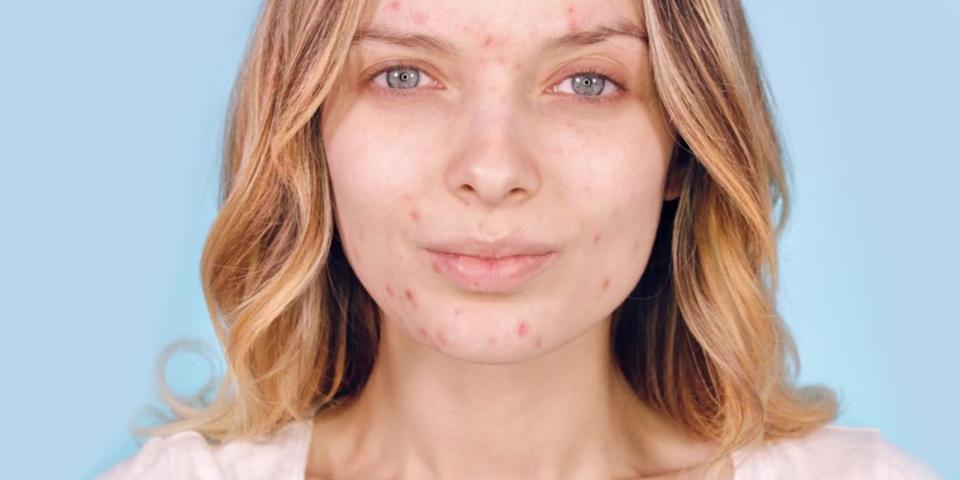 <p>Certains ne comprennent pas ce mouvement et postent des commentaires désobligeants du style : “Tu me dégoûtes”, voire profèrent même des insultes. Crédit photo : Instagram mypaleskinblog </p>