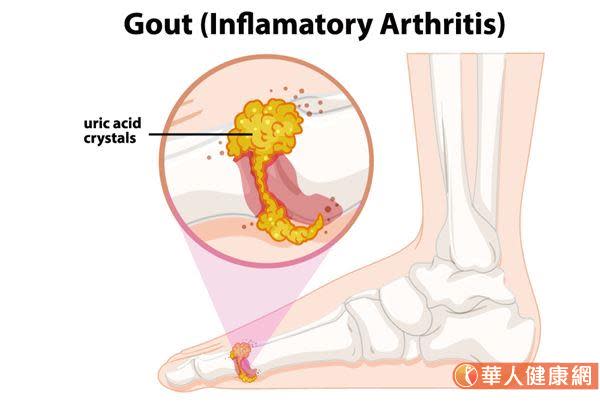 誰說痛風只有冬天才會發作？夏天做錯這些事，小心同樣容易好發