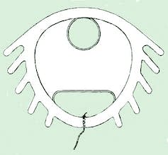 Sketch of a Dalkon shield IUD