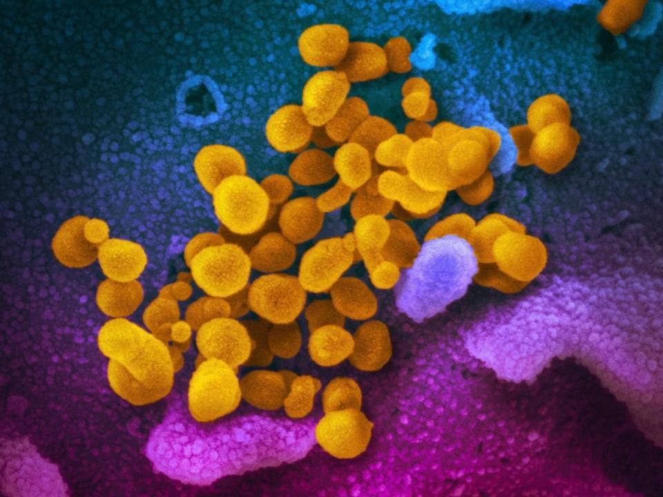 The virus that causes COVID-19 is seen emerging from the surface of cells, cultured in a lab. The N.W.T. is reporting 207 cases of COVID-19 across the territory, a decrease of 58 since Friday. (NIAID-RML/CP - image credit)