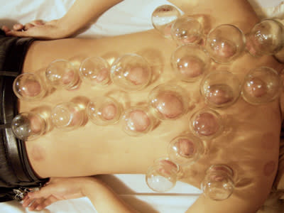 8. Heat cupping