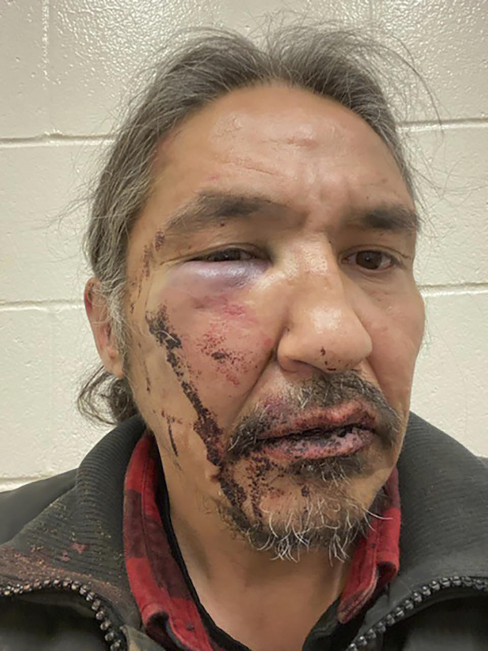 This March 10, 2020 photo provided by Chief Adam, shows the bloodied face of Athabasca Chipewyan First Nation Chief Allan Adam after a confrontation with Royal Canadian Mounted Police. Canadian Prime Minister Justin Trudeau says police dashcam video of the violent arrest of the Canadian aboriginal chief is shocking and not an isolated incident. The arrest has received attention in Canada as a backlash against racism grows in the wake of the death of George Floyd, a black man who died after a white Minneapolis police officer pressed a knee to his neck. (Allan Adam/The Canadian Press via AP)