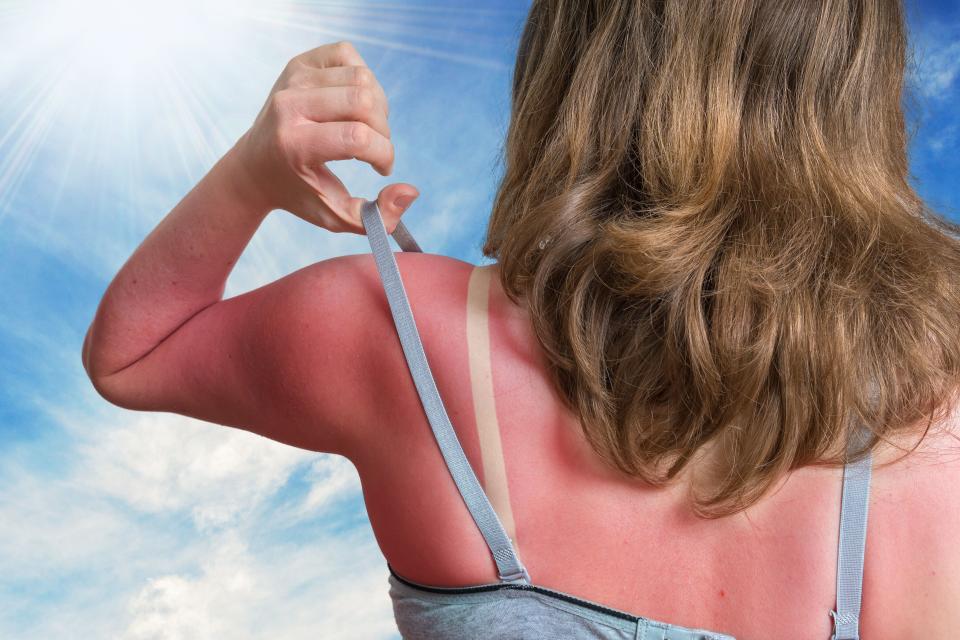 She needs a washcloth soaked in cold milk, immediately. (And a bottle of sunscreen for the future.) (vchal via Getty Images)