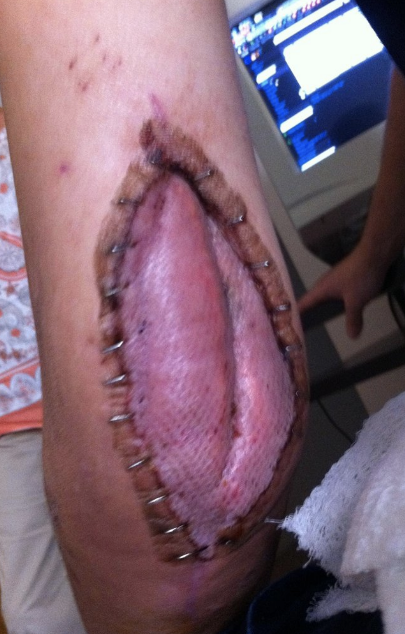 Close-up of a person's limb showing staples and a huge, open incision