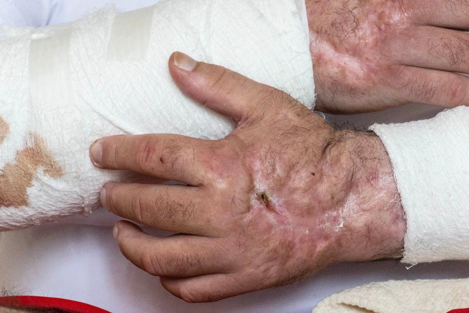 A close-up of Anthony's bandaged arms and scarred hands is featured at his mother's home in Lewes, Thursday, Sept. 7, 2023. Anthony, who has struggled with addiction for the last nearly 15 years, recently almost lost both arms due to xylazine, known as "tranq dope."