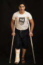 In this Sept. 19, 2018, photo, Hassan Abu Houdi, 19, poses as he awaits treatment at a Gaza City clinic run by MSF (Doctors Without Borders). Houdi says he was shot in his right leg while protesting. (AP Photo/Felipe Dana)