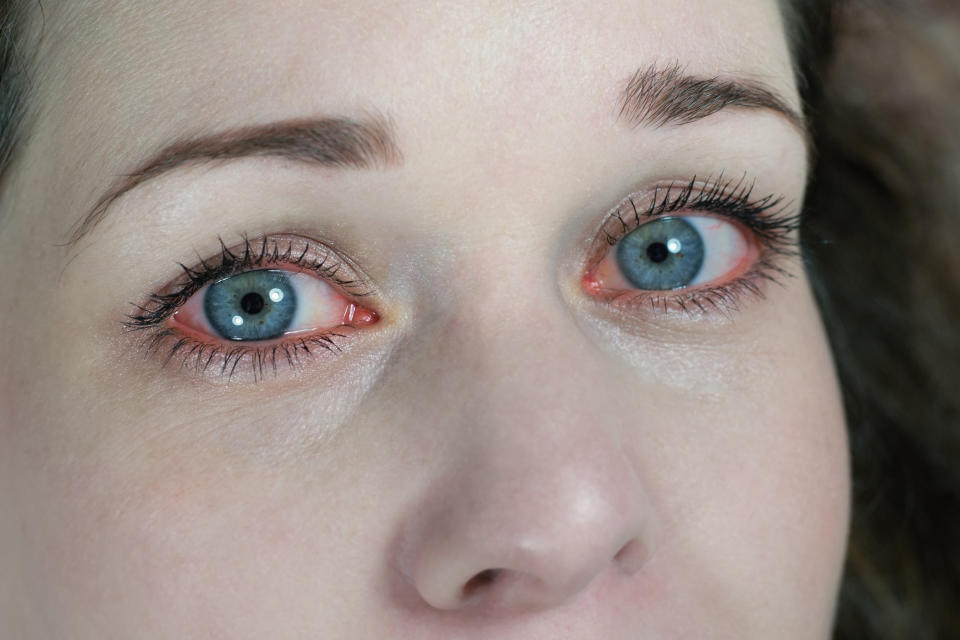 An image of a woman's blue eyes with red rims