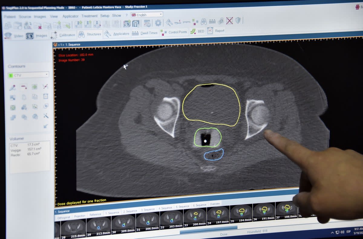 A doctor points at a screen with the tests of a patient suffering from cervical cancer during her first session of 3D high rate brachytherapy at the Bolivian Radiotherapy and Oncology Institute (IBRO) in El Alto, Bolivia (AFP via Getty Images)