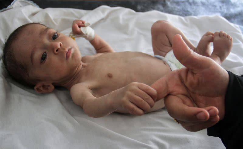 Six-month-old with chest infection in Gaza shows how children starve