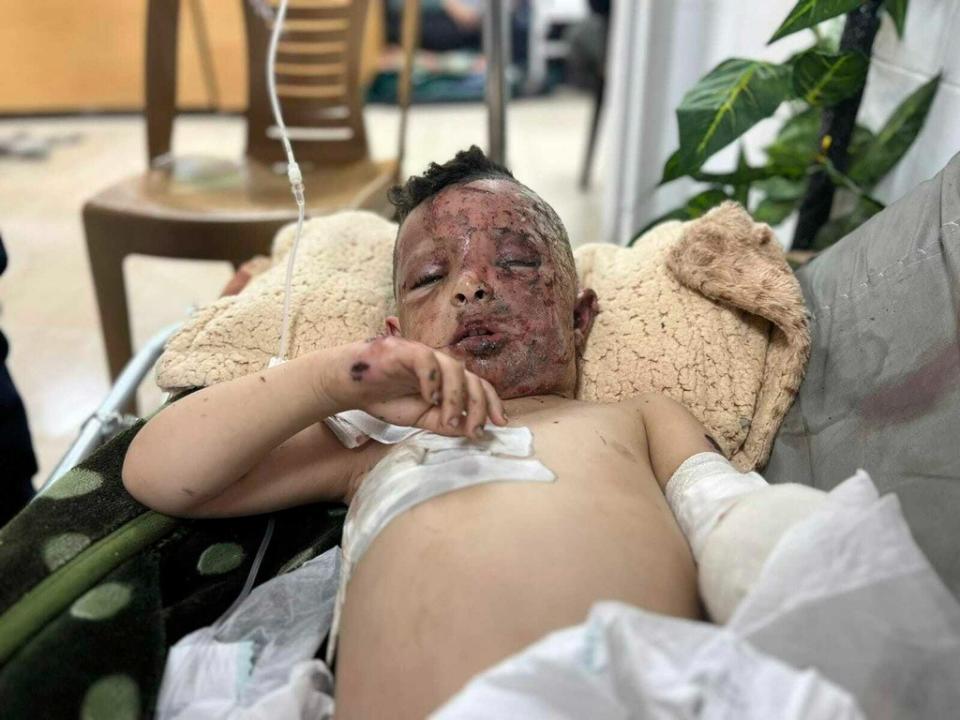 加薩走廊4歲男童歐瑪在以軍空襲中失去左手前肢，身上多處燒傷。美聯社