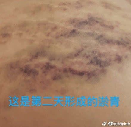 屈楚蕭在前女友黎梵背部留下大片傷痕。（圖／翻攝自黎梵微博）