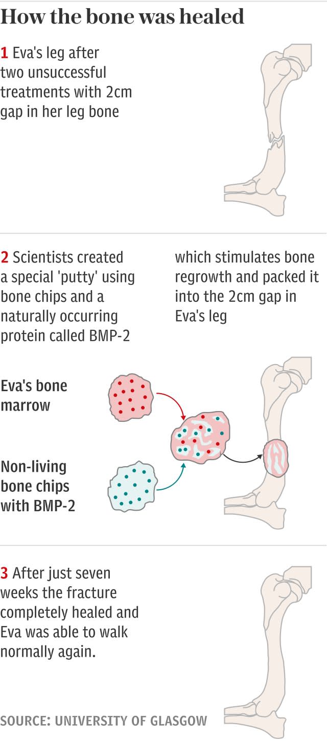 How the bone was healed