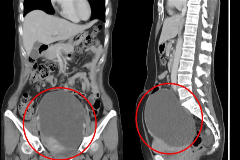 電腦斷層顯示家芸的腹部內有一顆16公分的巨大卵巢腫瘤。（圖／翻攝自花蓮慈濟醫院臉書）