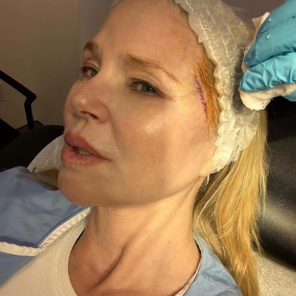 The former supermodel shared an image of herself with bandages on her forehead. christiebrinkley/Instagram