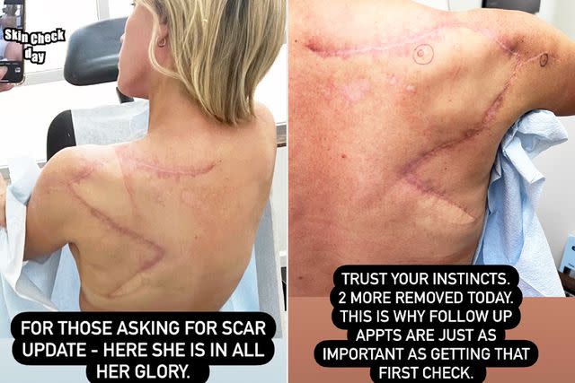 <p>Teddi Mellencamp/Instagram</p> Teddi Mellencamp shares her scars on Instagram.