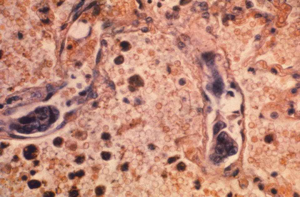 This 1964 photo made available by the Centers for Disease Control and Prevention shows a lung tissue specimen from a patient with adenocarcinoma of the lung. On Wednesday, Jan. 8, 2020, researchers reported the largest-ever decline in the U.S. cancer death rate, and they are crediting advances in the treatment of lung tumors. Most lung cancer cases are tied to smoking, and decades of declining smoking rates means lower rates of lung cancer diagnoses and deaths. (Dr. Ellis/Emory University, Department of Pathology/CDC via AP)