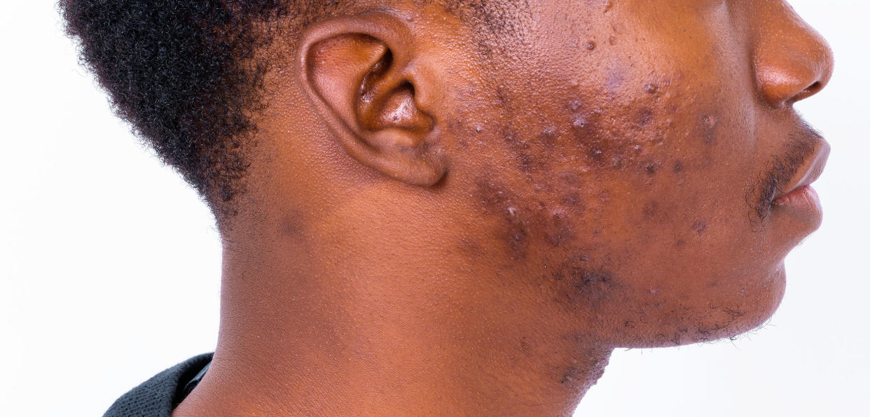 About skin conditions and photos of acne on black African American skin (Getty Images)