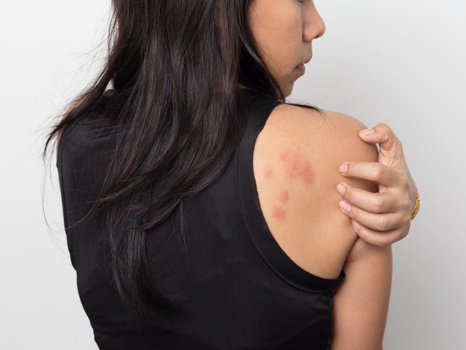 stress rash and hives on woman's back