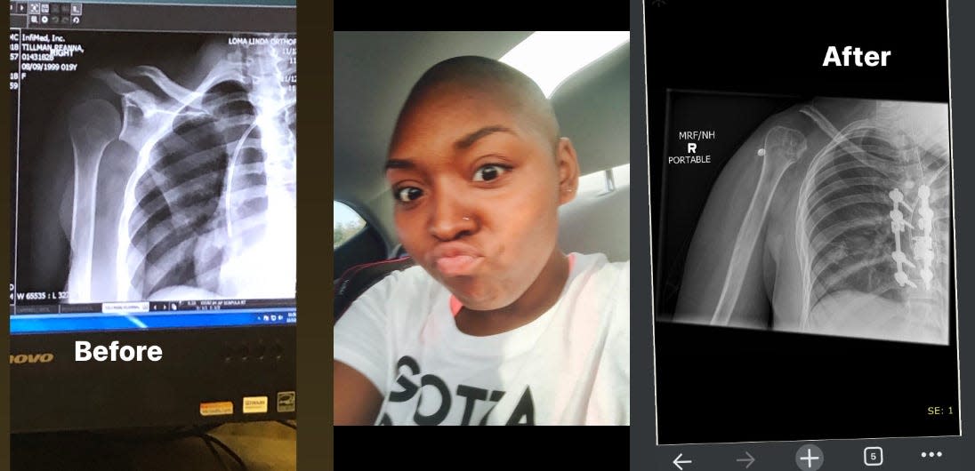 Reanna Tillman's shoulder scans: before, selfie, and after