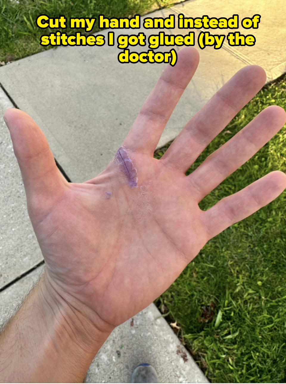 A close-up of an open hand with a visible purple bruise or mark on the palm, taken outdoors on a sidewalk with grass nearby