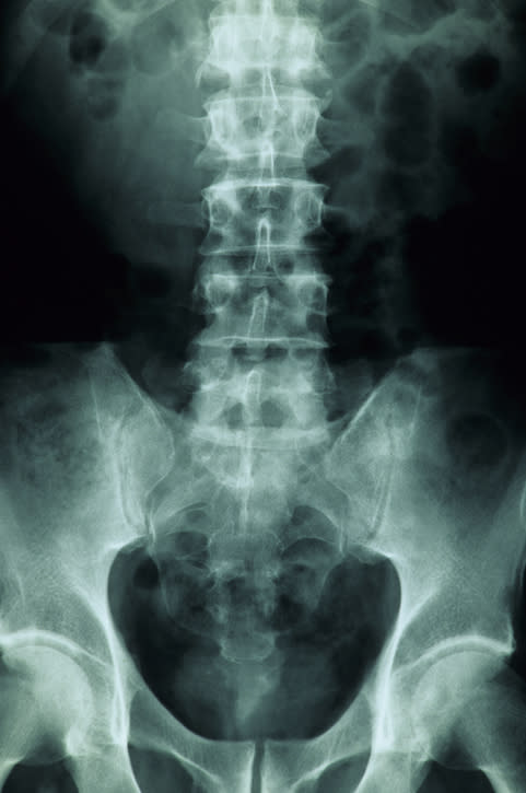 A scan of someone's spine