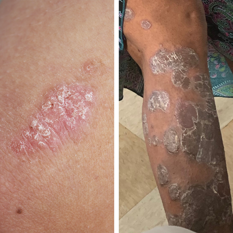 <p><strong>What it looks like</strong>: Psoriasis causes patches of thickened skin, most often with <a href="https://www.prevention.com/health/health-conditions/a20965002/psoriasis-types/" rel="nofollow noopener" target="_blank" data-ylk="slk:silver, scaly flakes" class="link ">silver, scaly flakes</a>. It’s usually found around the elbows, feet, knees, palms, and you can even have <a href="https://www.prevention.com/health/health-conditions/a20123786/scalp-psoriasis/" rel="nofollow noopener" target="_blank" data-ylk="slk:scalp psoriasis" class="link ">scalp psoriasis</a>.</p><p><strong>Other symptoms to note</strong>: Telltale scales set psoriasis apart from other rashes. Per the <a href="https://www.cdc.gov/psoriasis/index.htm" rel="nofollow noopener" target="_blank" data-ylk="slk:CDC" class="link ">CDC</a>, up to 20% of people with psoriasis also experience <a href="https://www.prevention.com/health/health-conditions/a36398308/psoriatic-arthritis-facts/" rel="nofollow noopener" target="_blank" data-ylk="slk:psoriatic arthritis" class="link ">psoriatic arthritis</a>. Psoriasis is not contagious; it’s due to “overactivity of the immune system resulting in skin inflammation,” Dr. Zeichner explains.</p><p><em>Right image credit: <a href="https://www.flickr.com/photos/timkubacki/49567658751/in/photolist-2iw8d34-2hdpve7-2hdqmph-2hdnNv2-2hdqmq4-jfjutK-jfnSN8-jfoWcZ-jfoKBn-jfpu3o-jfophe-jfpp5B-8mURX6-jfmabk-jfnTrc-jfqvZs-LSpPCV-8mURJR-5hySVg-8mURQv-eo8cY8-ULQNbs-eoH2yy-eoH5Xm-7978Dd-eo8ud8-eoHeDu-eo8uPK-eoGZdu-eo8j7K-eo8hpH-eoH8yh-eo8oSM-eoH9ud-eoHhHy-eo8qZi-eoHbpQ-eoH1Gb-eoHdqC-eoH7cw-eoH6vj-eoH93m-eoHe9S-eoH3Vs-eo8rWe-eoH7M1-eo8iC8-eo8jCP-dqxgky-eo8rzz" rel="nofollow noopener" target="_blank" data-ylk="slk:Tim Kubacki" class="link ">Tim Kubacki</a></em></p>