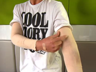 <p>Trent Forester shows off his bandages.</p>