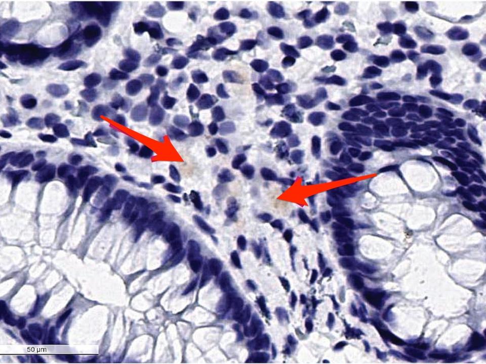 Arrows on a slide from the biopsy of the girl's gut point to brownish cells among a background of purple cells.