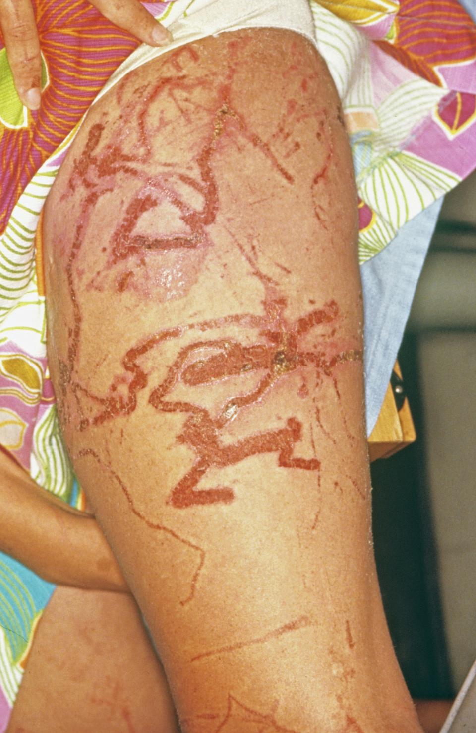 La necrosis en la piel es una de las causas de la picadura de la cubomedusa. (Getty Images).