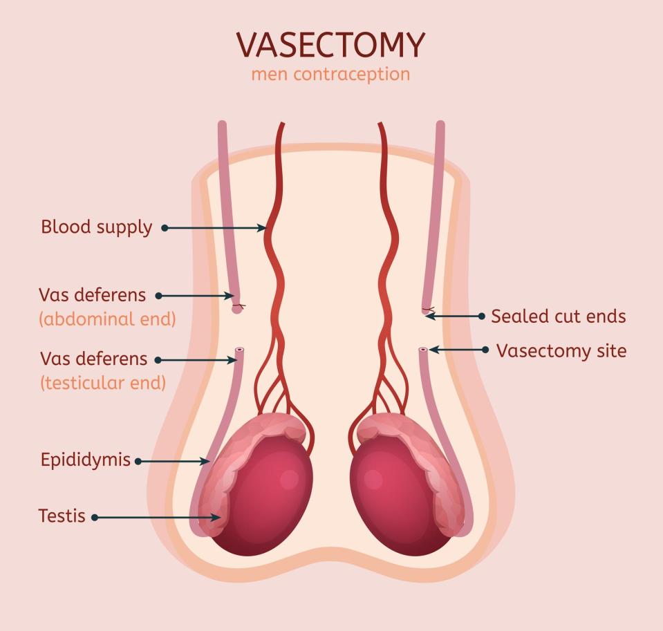 The most permanent form of birth control men currently have available to them is vasectomy.
