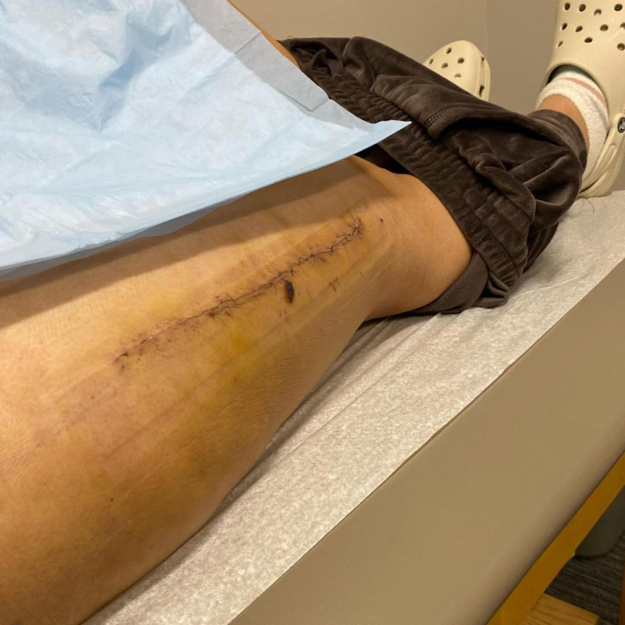 Doctors were hoping to avoid surgery, but when Franco developed acute compartment syndrome in her right leg, she had to undergo a fasciotomy. (Courtesy Kaelyn Franco)