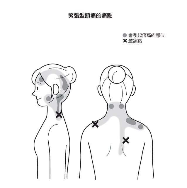 緊張型頭痛的痛點