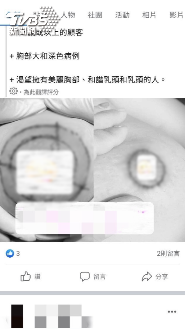 阮女在臉書發布縮乳暈手術廣告。（圖／TVBS）