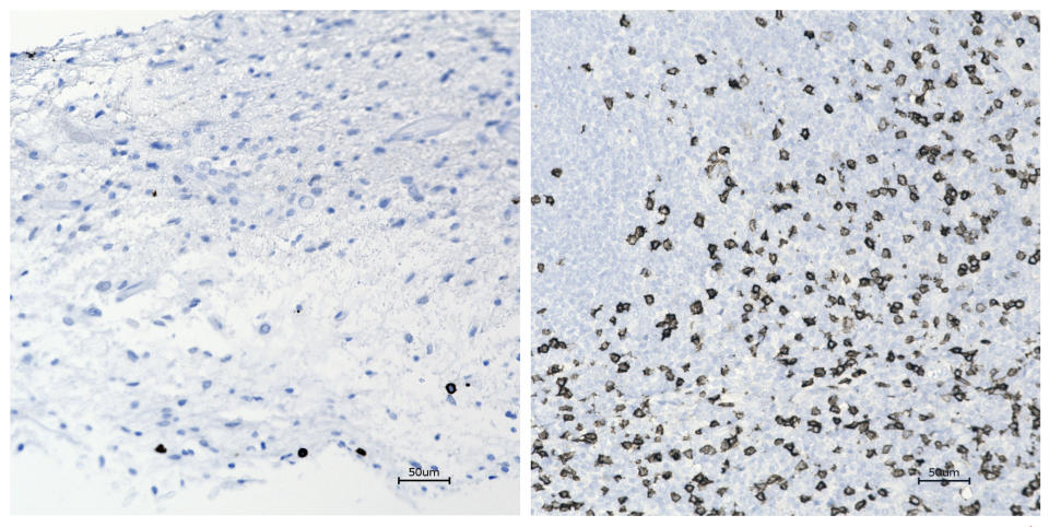 This combination of microscope images provided by the University of Alabama in April 2021 shows immune cells within in the brain tumor of a child, before and after a treatment that involves using viruses to spur an immune system response to the cancerous cells. The image at right shows an increase in activated immune cells, indicated in brown. (UAB via AP)