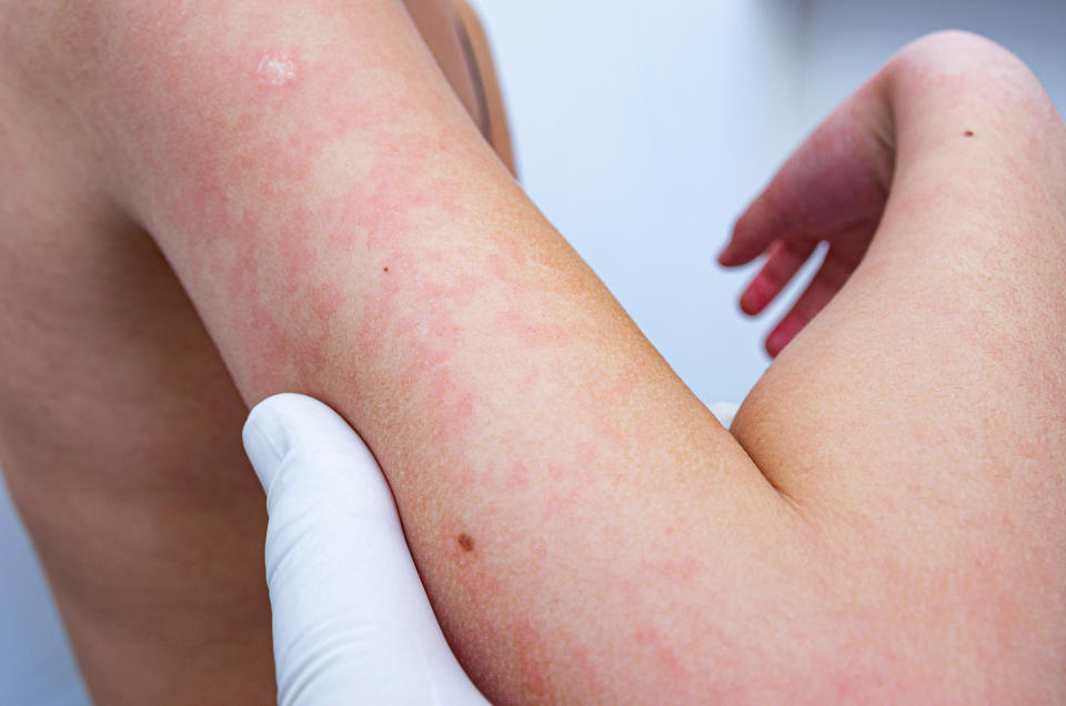A rash is one of the symptoms of meningitis, but there are several others to look out for. (Getty Images)