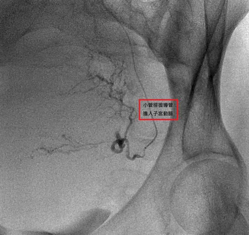 血管攝影影像顯示導管進入子宮動脈進行栓塞。（圖／亞東醫院提供）