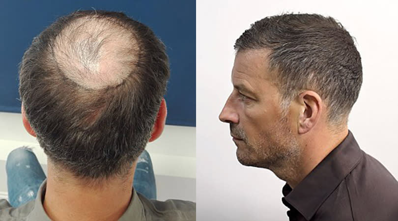 Mark Clattenburg 1 – Barnet 0: The former Premier League referee shows off his hair transplant