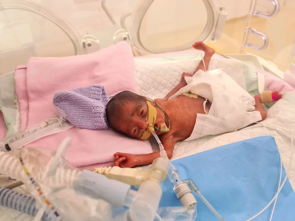 Micro preemie Eloise Ang Xuan Rui weighed only 670g at birth.  —  Picture courtesy of One Hope Charity &amp; Welfare