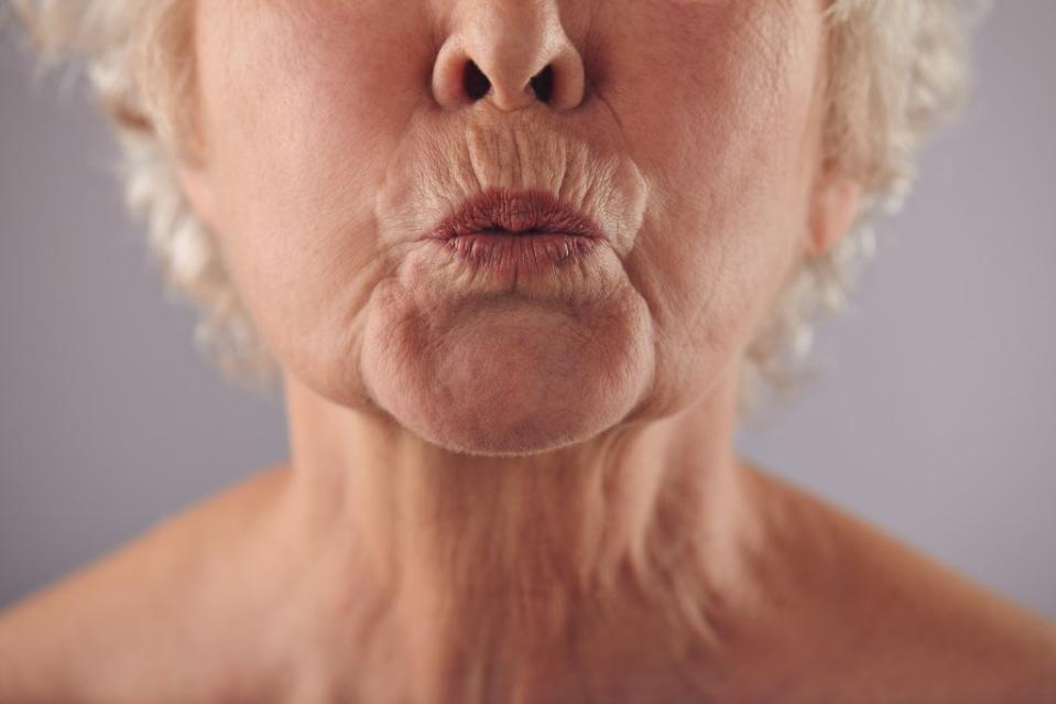 Lip wrinkles — sometimes referred to as lip lines, lipstick lines or smoker’s lines — are vertical ridges that develop along and above your upper lip. Jacob Lund – stock.adobe.com