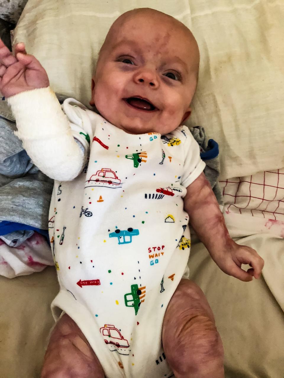 Little Kaiden is now six months old and happier than ever! [Photo: SWNS]