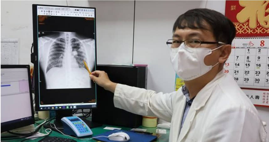 東南亞的30多歲外籍男移工肺部鈣化還潰爛竟無感，醫嘆：是肺癌。（圖／李綜合醫院提供）