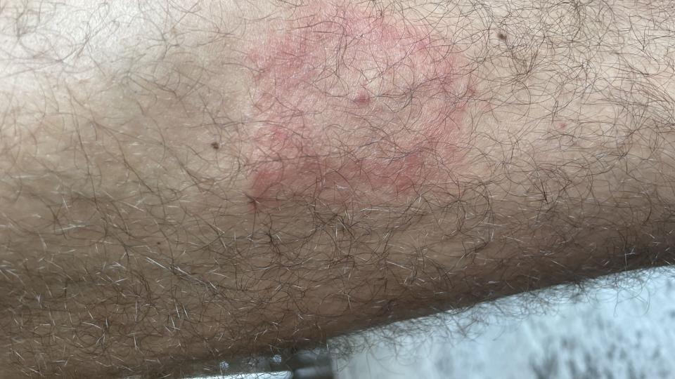 wh skin rashes tick bite lyme disease photo credit nico shapiro
