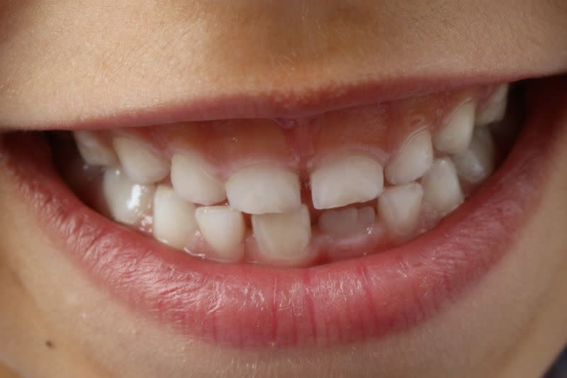 ▲牙齒是一個人的門面，若沒有正確、勤勞保養，未來就必須付出大量金錢挽救。（示意圖／翻攝Pixabay）