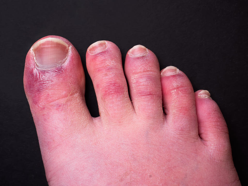 Researchers have pinpointed what causes the chillblain-type legions on the foot. (Getty Images)