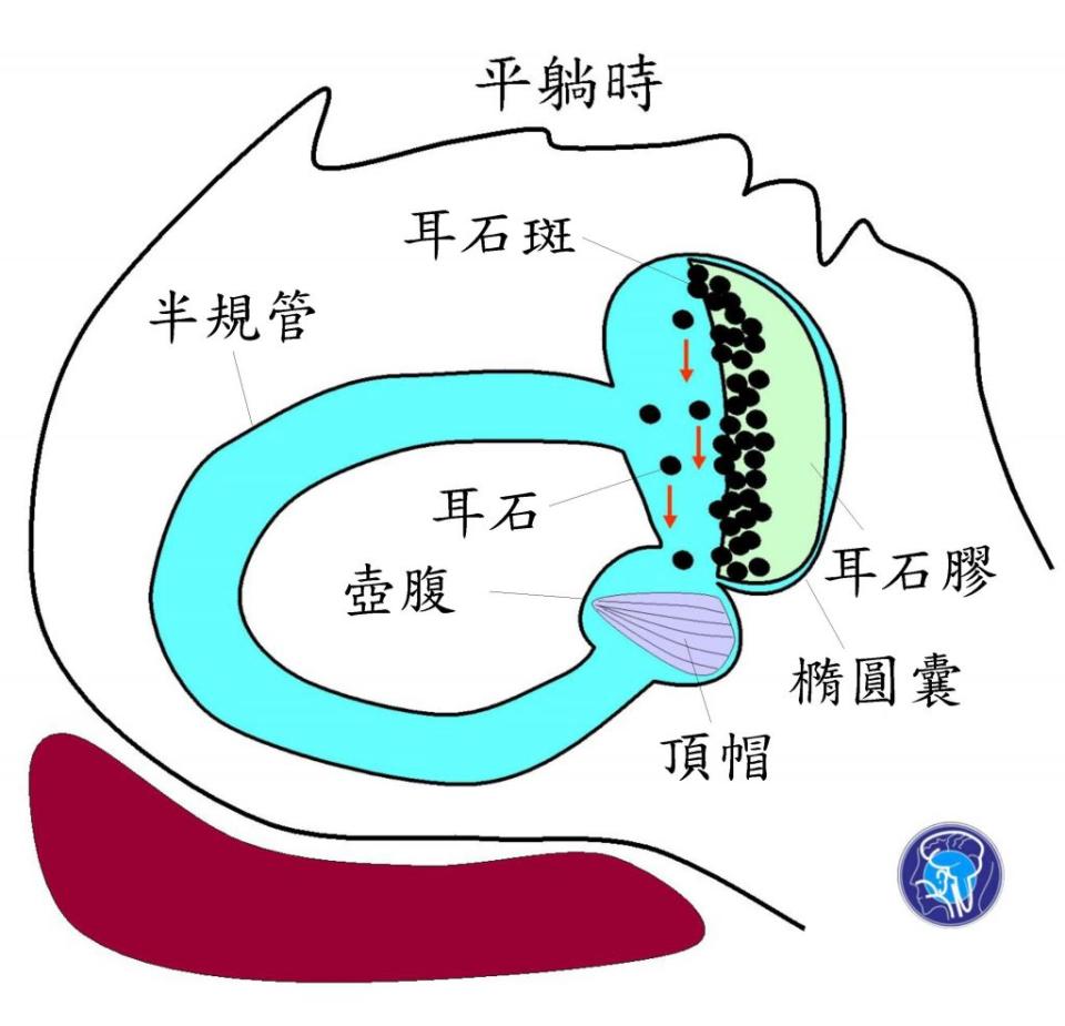 老年人耳石膠生成不良，睡眠平躺時橢圓囊翹起來，耳石斑呈垂直宛如懸崖峭壁，耳石依著重力逐漸崩落。（醫師陳建志提供）