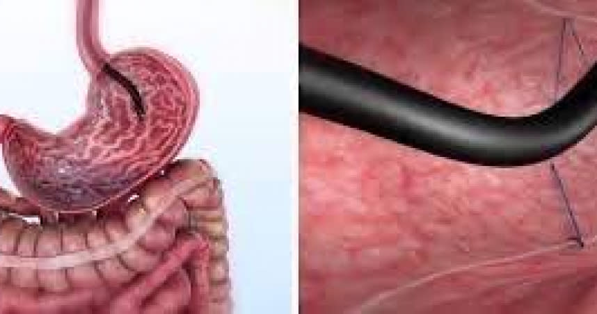 胃鏡由口進入胃內(左圖)，再經由胃鏡特殊縫合系統將胃做袖狀對縫縮小體積。（圖／翻攝亞東醫院提供)