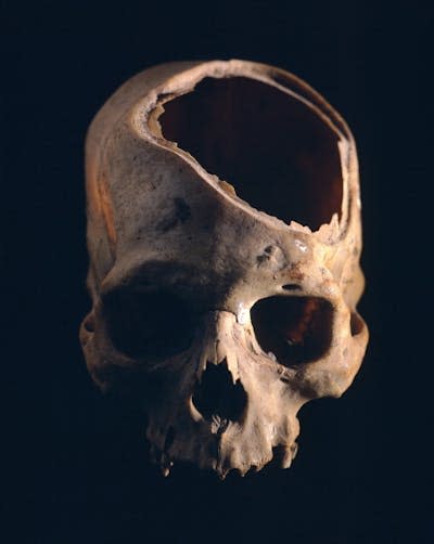 This skull of a person who lived more than 2,600 years ago in Peru shows evidence of a surgery, maybe to treat a head wound.