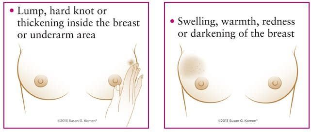 Most breast lumps indicate something other than breast cancer—some possible causes for breast lumps include <a href="http://www.cancer.org/cancer/breastcancer/detailedguide/breast-cancer-what-is-breast-cancer" target="_hplink">cysts, fibrosis, or benign tumours</a>. And some women are just prone to lumpy breasts, which is stressful but harmless. That said, if you find a lump, get it checked out — know that the odds are good that it's nothing serious, but see your doctor about it for your own peace of mind.