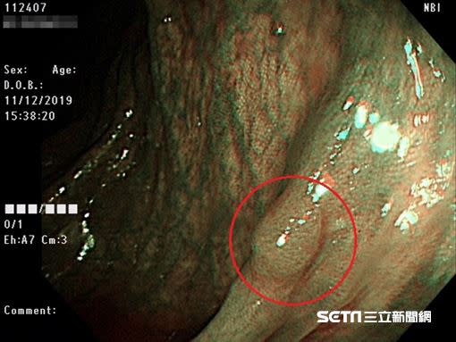 大腸鏡檢查出一顆「管狀腺瘤」，醫師當下切除、送化驗。