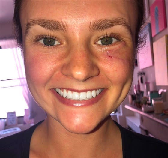 Gibson Miller smiling for a photo after surgery, showing a small scar under her left eye. 